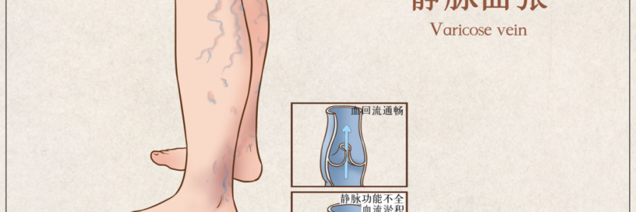 告別“蚯蚓腿”，靜脈曲張怎么調(diào)？