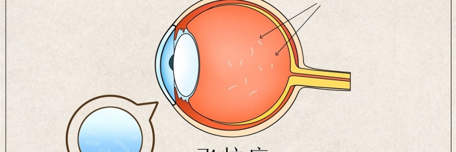 “蚊子”在眼里飛？這類人要注意了！