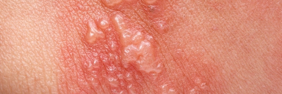 艾灸后起了小水泡，居然是邪氣在“逃跑”！