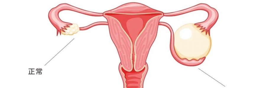 太神奇了，艾灸調(diào)好了她的卵巢囊腫！